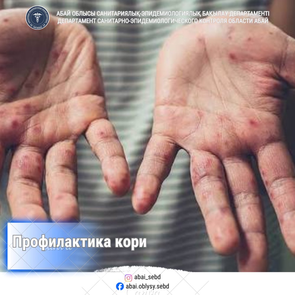 ҚЫЗЫЛША — ҚАУІПТІ ВИРУСТЫҚ АУРУ
