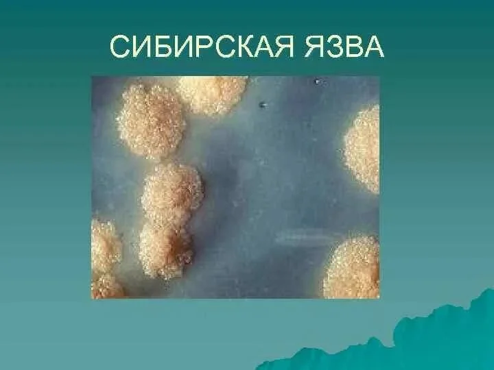 Сибирская язва